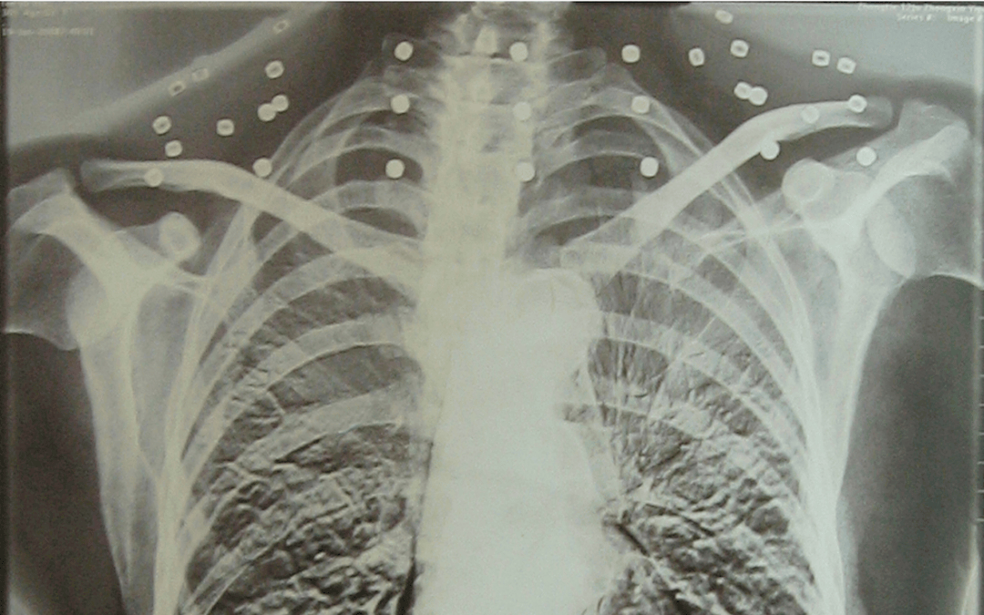 皇冠信用盘可以占几成
_“老先生皇冠信用盘可以占几成
,您把项链取下来再做CT”