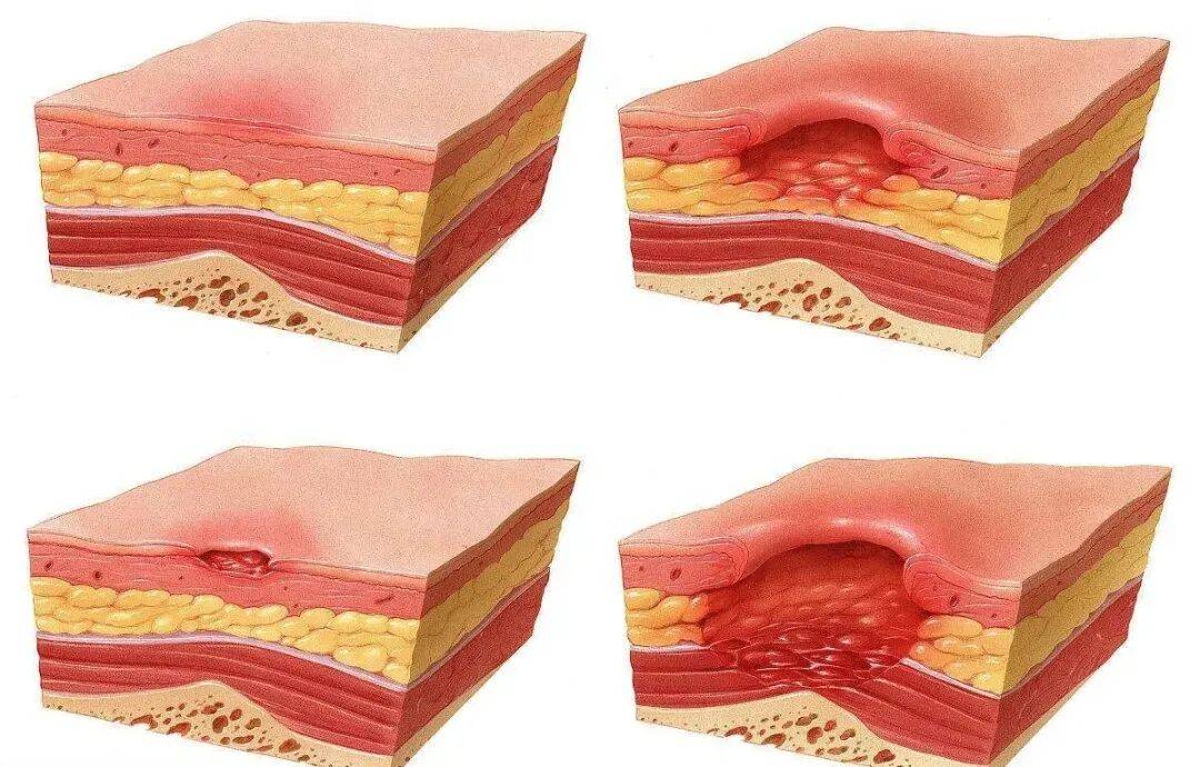 皇冠信用网代理_一觉醒来皇冠信用网代理，21岁女生的屁股惨不忍睹！严重或危及生命